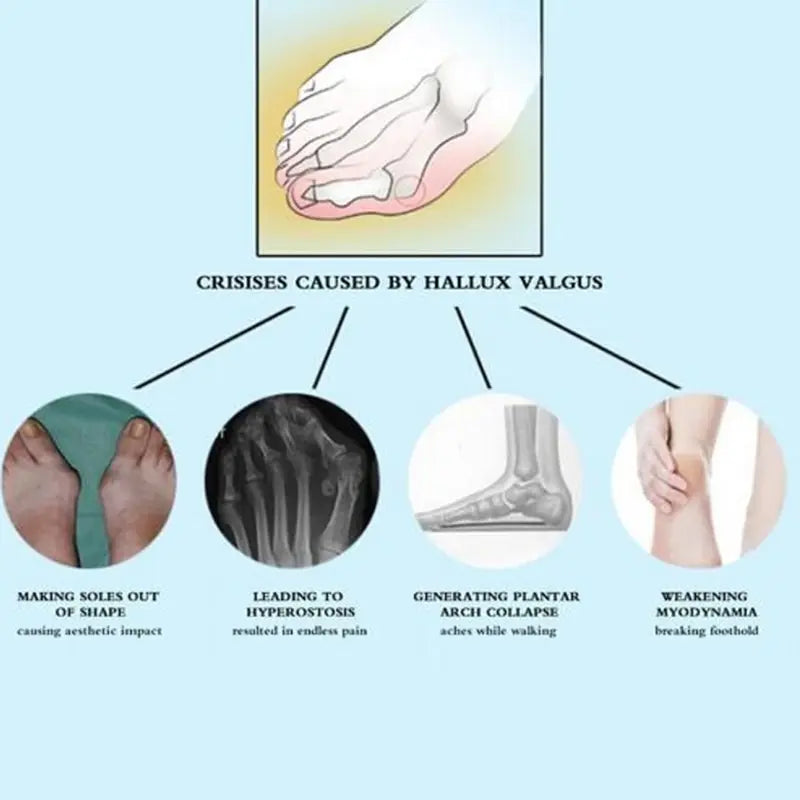 Bunion Splint Correction Adjustable Big Toe Corrector Braces Protector Hallux Valgus Straightener Foot Pain Relief Orthopedic