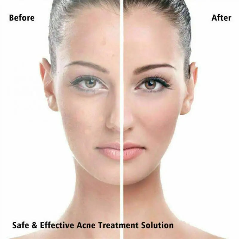 36Pcs Acne Puistje Patch Stickers Acne Behandeling Puistje Remover Tool Smet Spot Huidverzorging Waterdichte Stickers Beauty