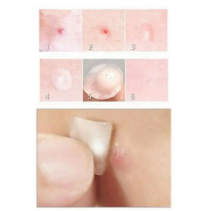 36Pcs Acne Puistje Patch Stickers Acne Behandeling Puistje Remover Tool Smet Spot Huidverzorging Waterdichte Stickers Beauty